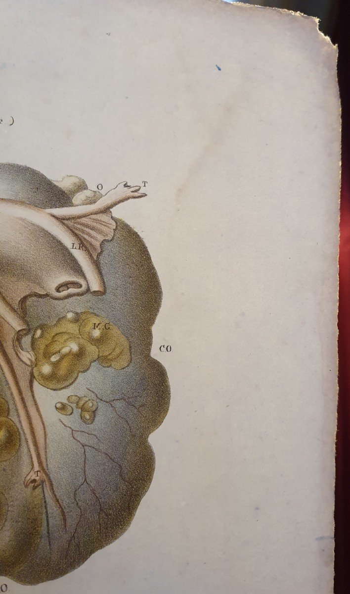 Color Engraving Anatomical Pathology Ovarian Cyst Disease By Jean Cruveilhier 1839 -photo-4