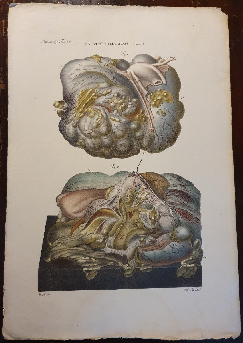 Color Engraving Anatomical Pathology Ovarian Cyst Disease By Jean Cruveilhier 1839 