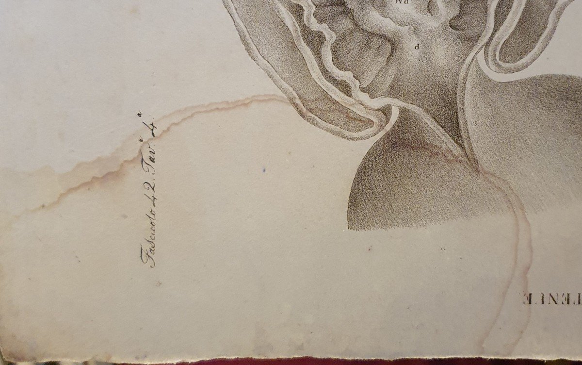 Engraving Anatomical Pathology Small Intestine Disease By Jean Cruveilhier 1839 -photo-3