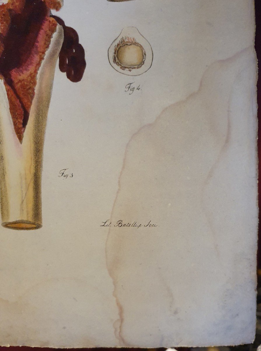 Gravure Couleur Anatomique Pathologique Fracture Col Du Fémur Par Jean Cruveilhier 1839 -photo-4