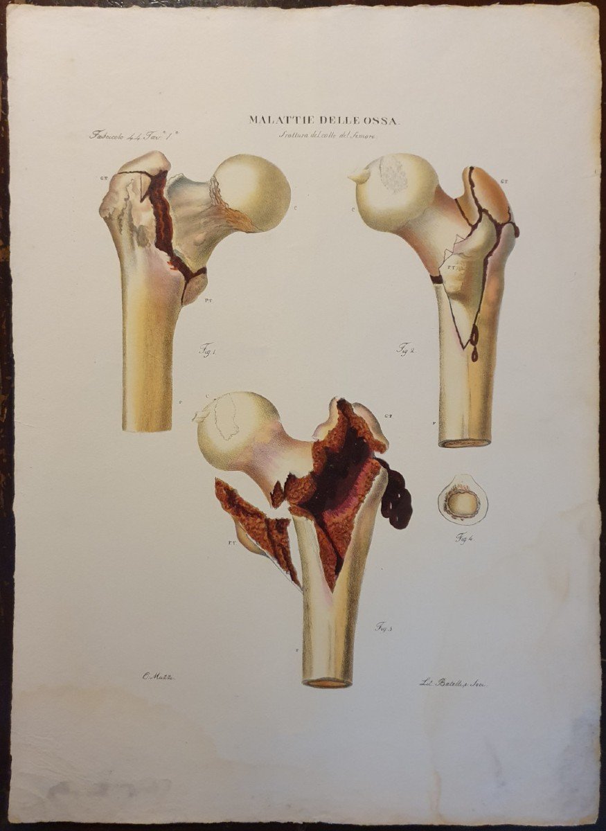 Gravure Couleur Anatomique Pathologique Fracture Col Du Fémur Par Jean Cruveilhier 1839 