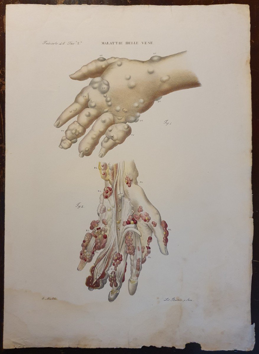 Gravure Couleur Anatomique Pathologique Maladie Des Veines Par Jean Cruveilhier 1839