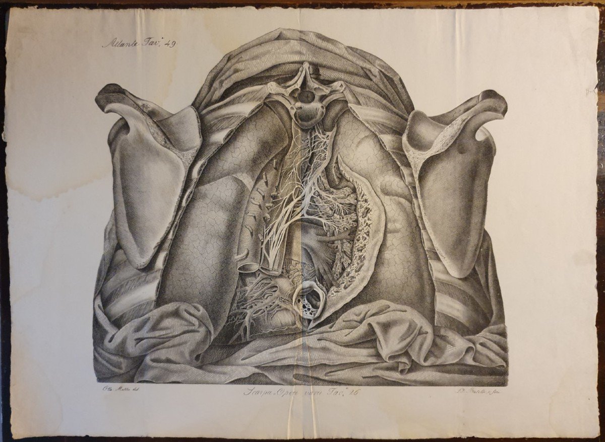 Black And White Engraving Anatomical Pathology Atlante Generale By Jean Cruveilhier 1839