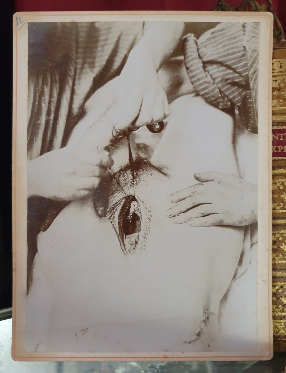 Curiosité : Six Photographies Médicales D’opération Début 20 ème Siècle (circa 1900 / 1905)-photo-4