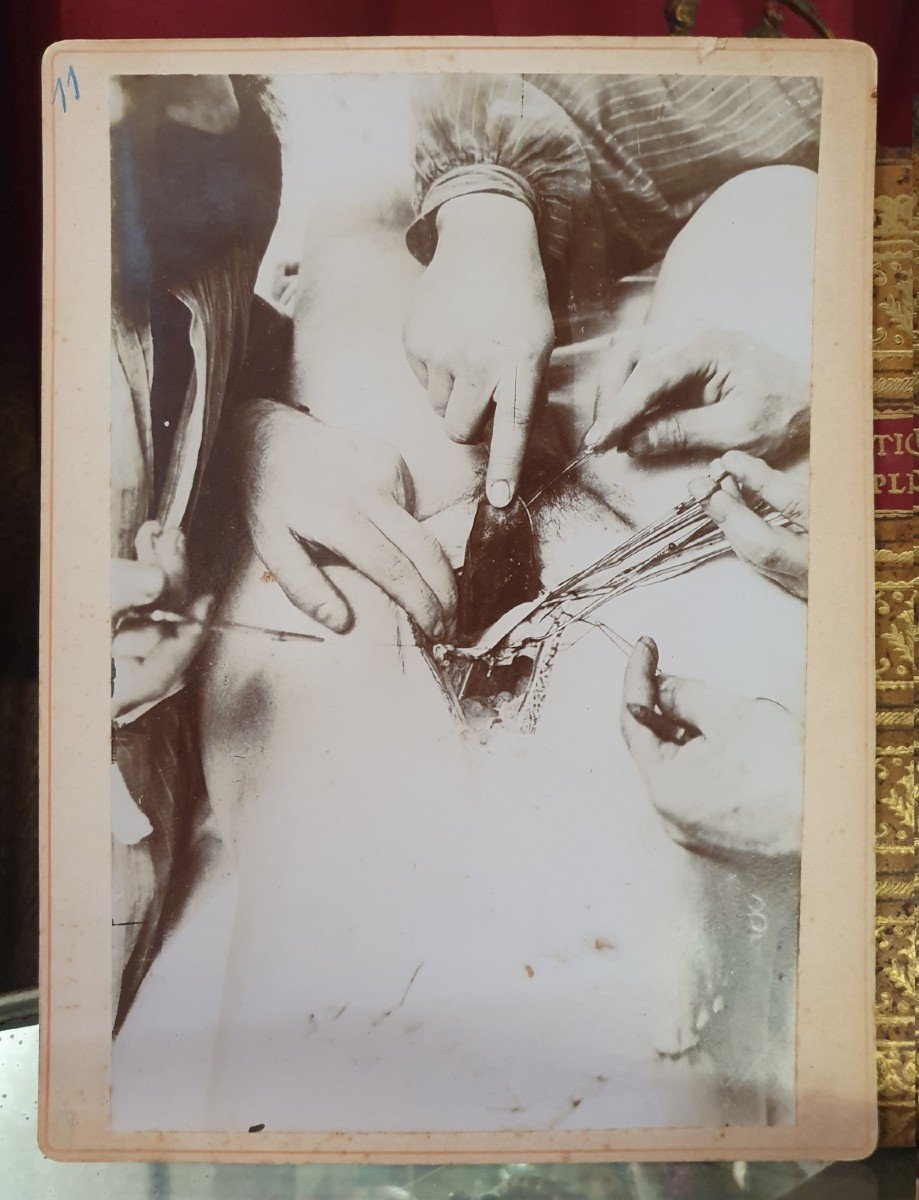 Curiosité : Six Photographies Médicales D’opération Début 20 ème Siècle (circa 1900 / 1905)-photo-2