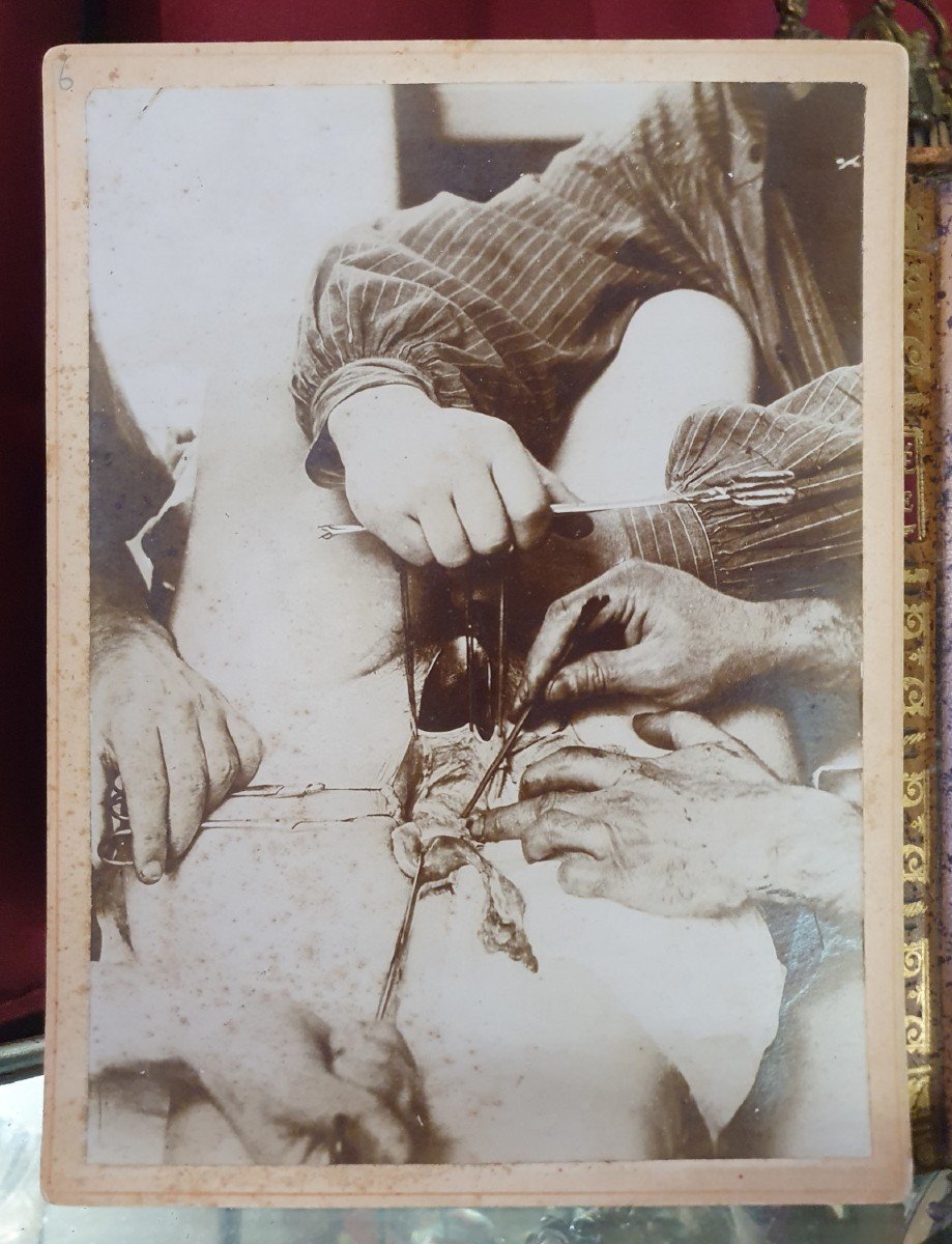 Curiosité : Six Photographies Médicales D’opération Début 20 ème Siècle (circa 1900 / 1905)-photo-4