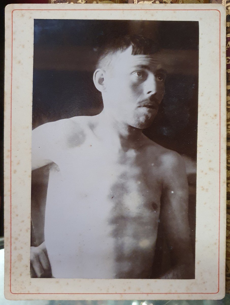 Curiosity: Three Medical Photographs Of A Clinical Case Of Dislocation Following An Accident-photo-3