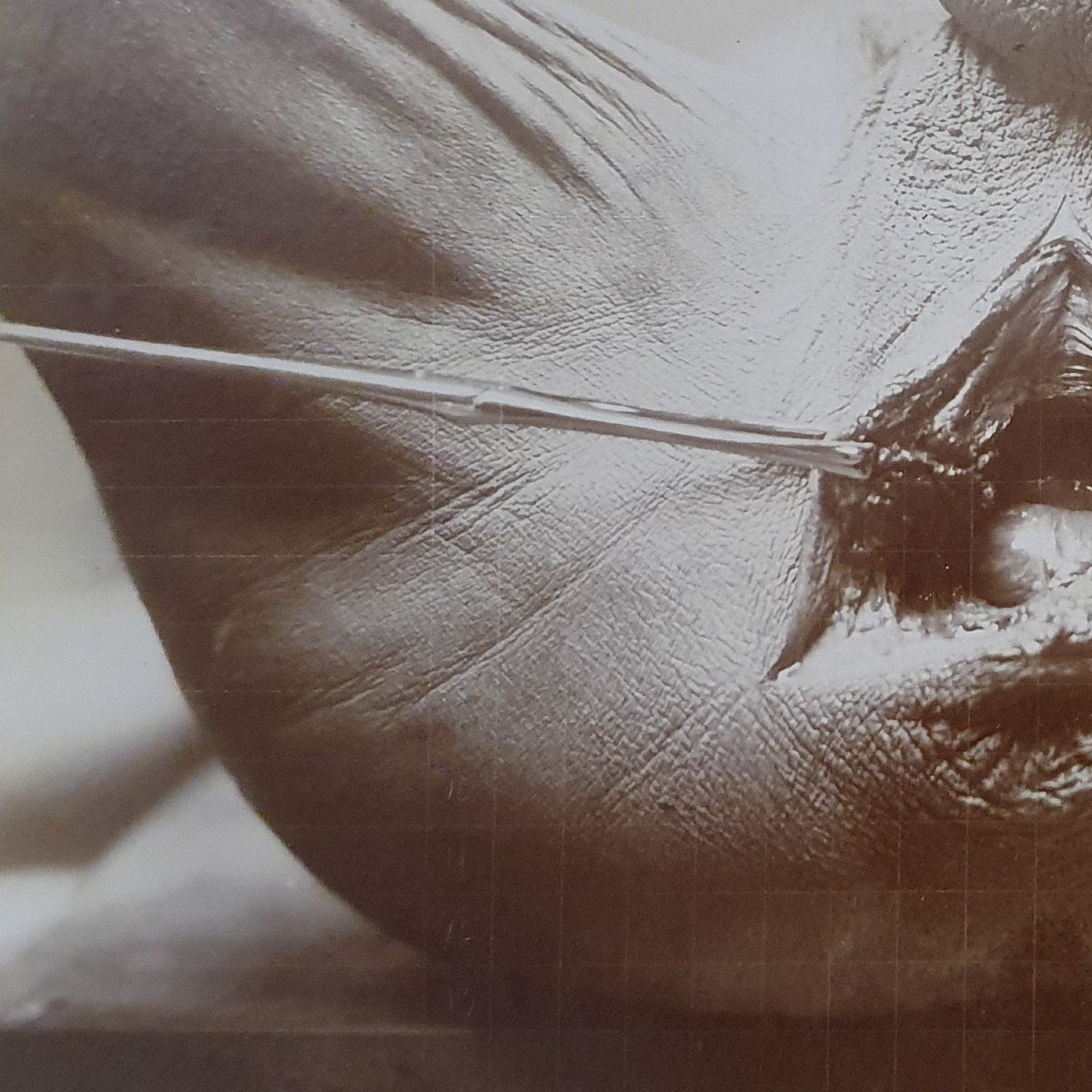 Curiosité : Trois Photographies Médicales D’une Opération, Début XX ème Siècle-photo-4