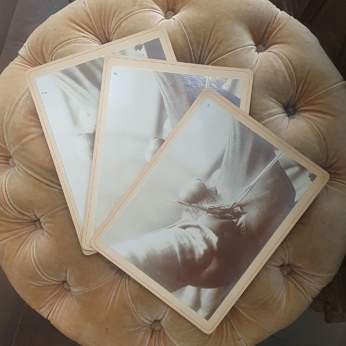 Curiosité : Trois Photographies Médicales D’une Opération, Début XX ème Siècle