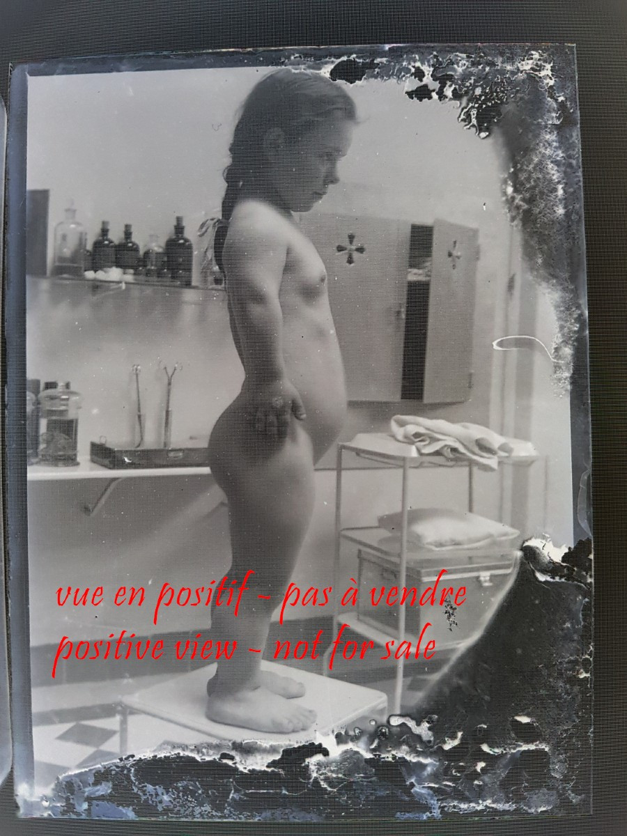 Pair Of Gelatin Silver Bromide Negative Plates Medical Curiosity Object - Dwarfism Child-photo-2