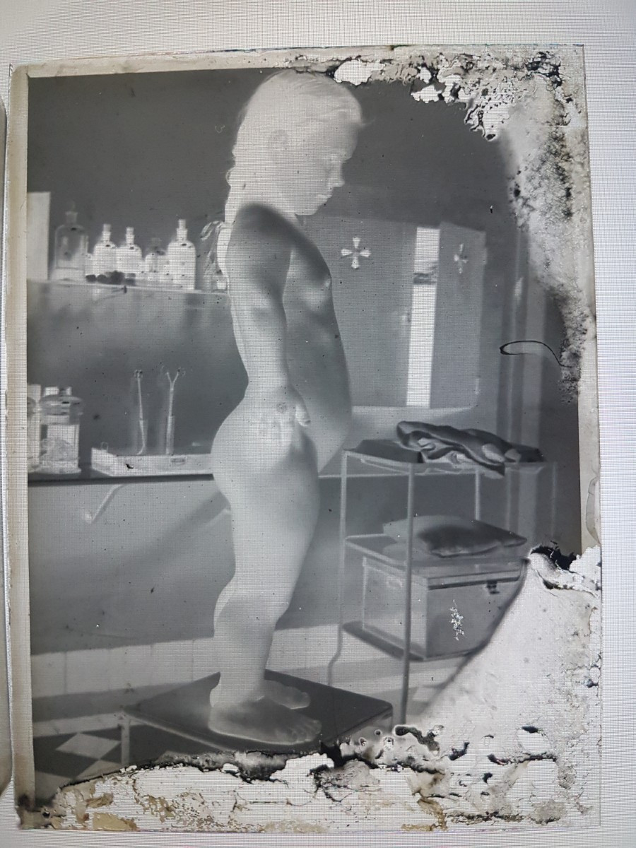 Pair Of Gelatin Silver Bromide Negative Plates Medical Curiosity Object - Dwarfism Child