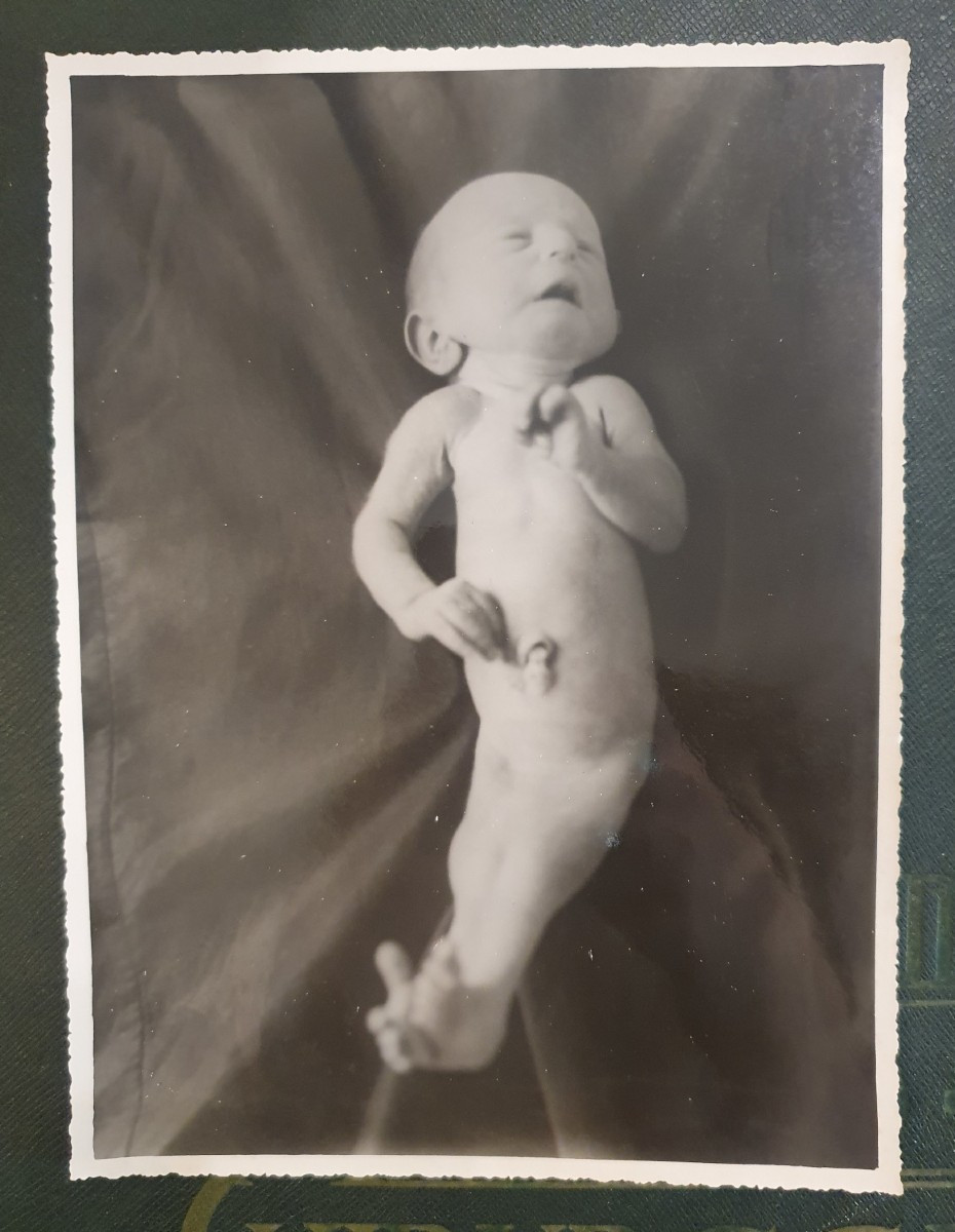 Historical Teratological Medical File On A Case Of Sirenomelia, 1936-photo-2
