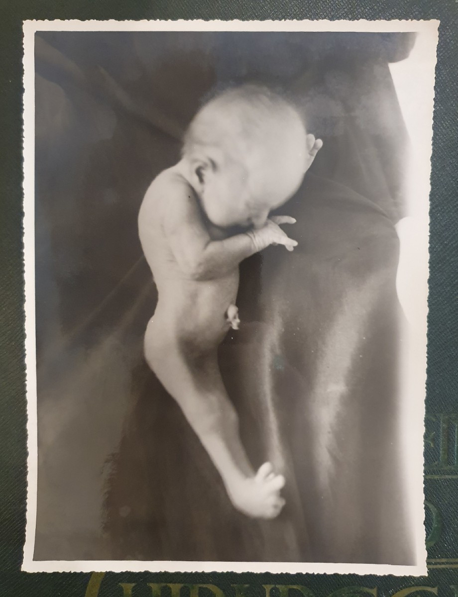 Historical Teratological Medical File On A Case Of Sirenomelia, 1936-photo-3