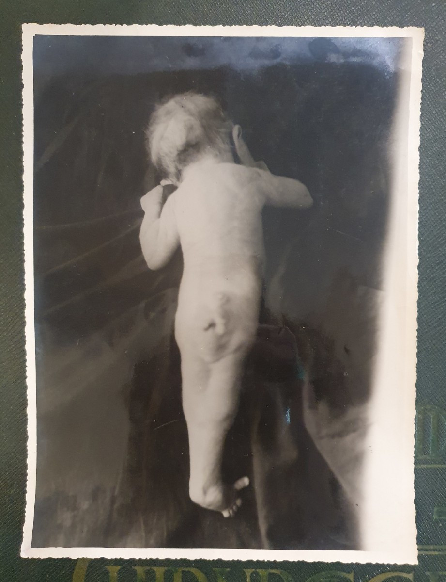 Historical Teratological Medical File On A Case Of Sirenomelia, 1936-photo-4