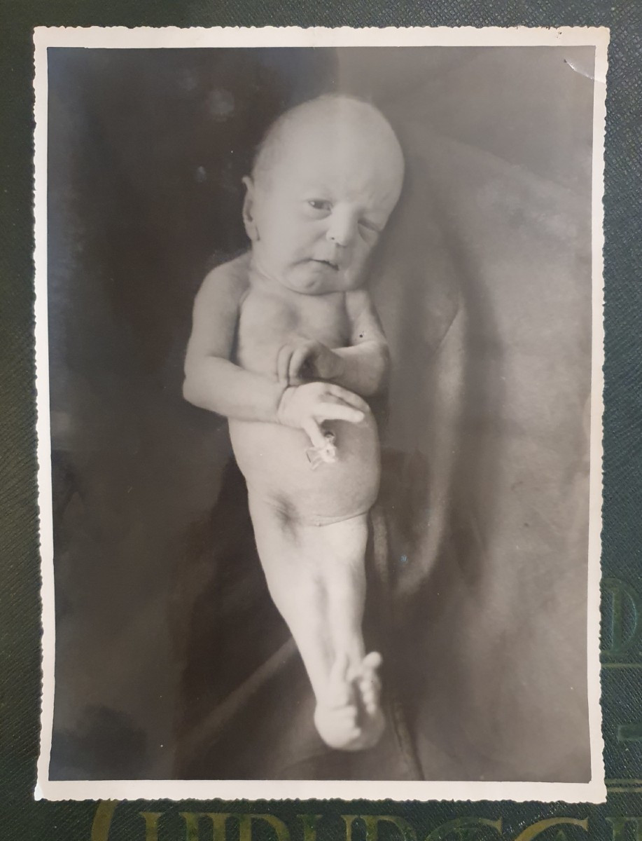 Historical Teratological Medical File On A Case Of Sirenomelia, 1936-photo-1