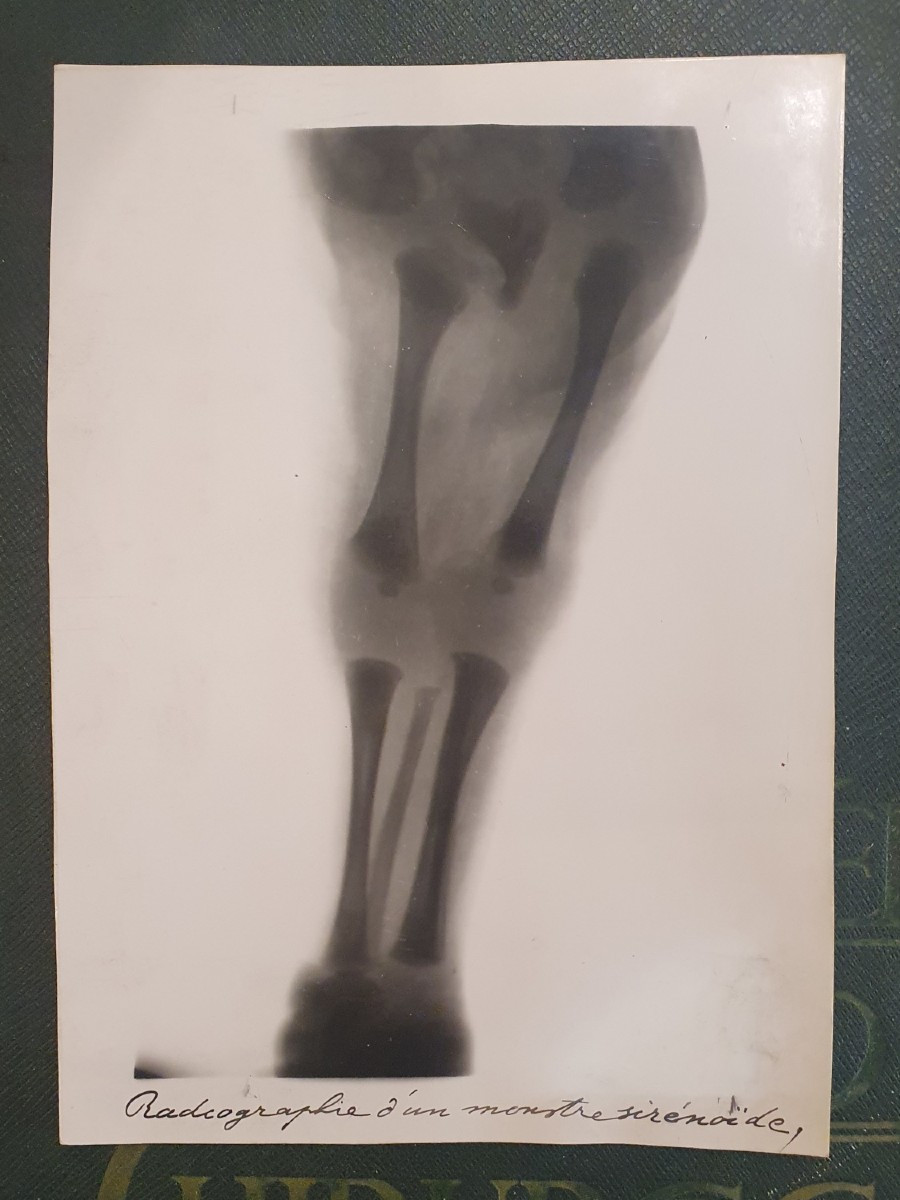 Historical Teratological Medical File On A Case Of Sirenomelia, 1936-photo-2