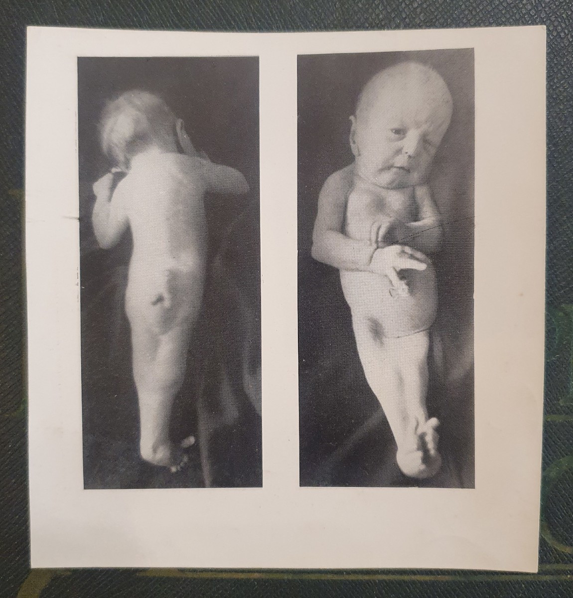 Historical Teratological Medical File On A Case Of Sirenomelia, 1936-photo-3