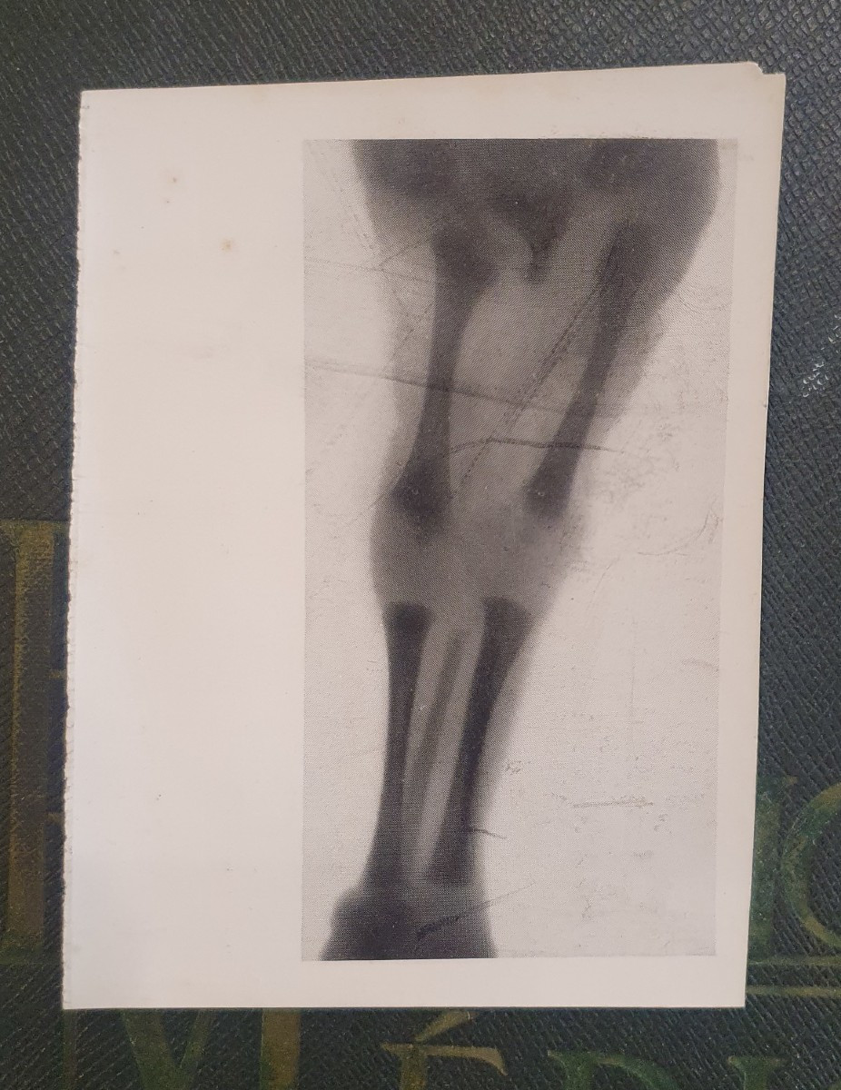 Historical Teratological Medical File On A Case Of Sirenomelia, 1936-photo-4