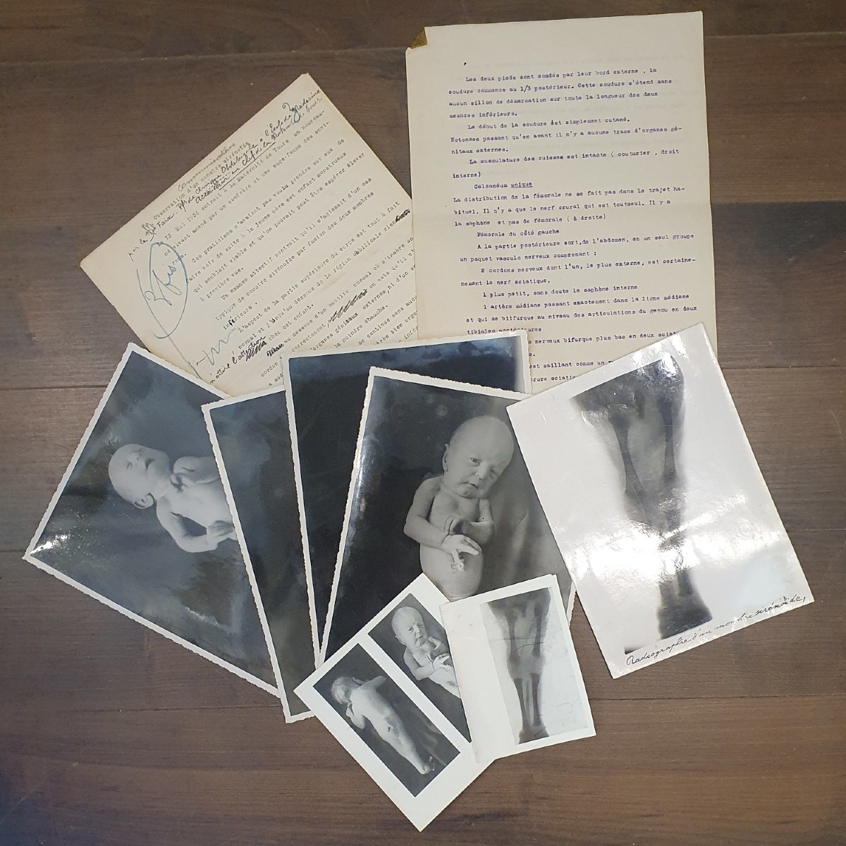 Historical Teratological Medical File On A Case Of Sirenomelia, 1936