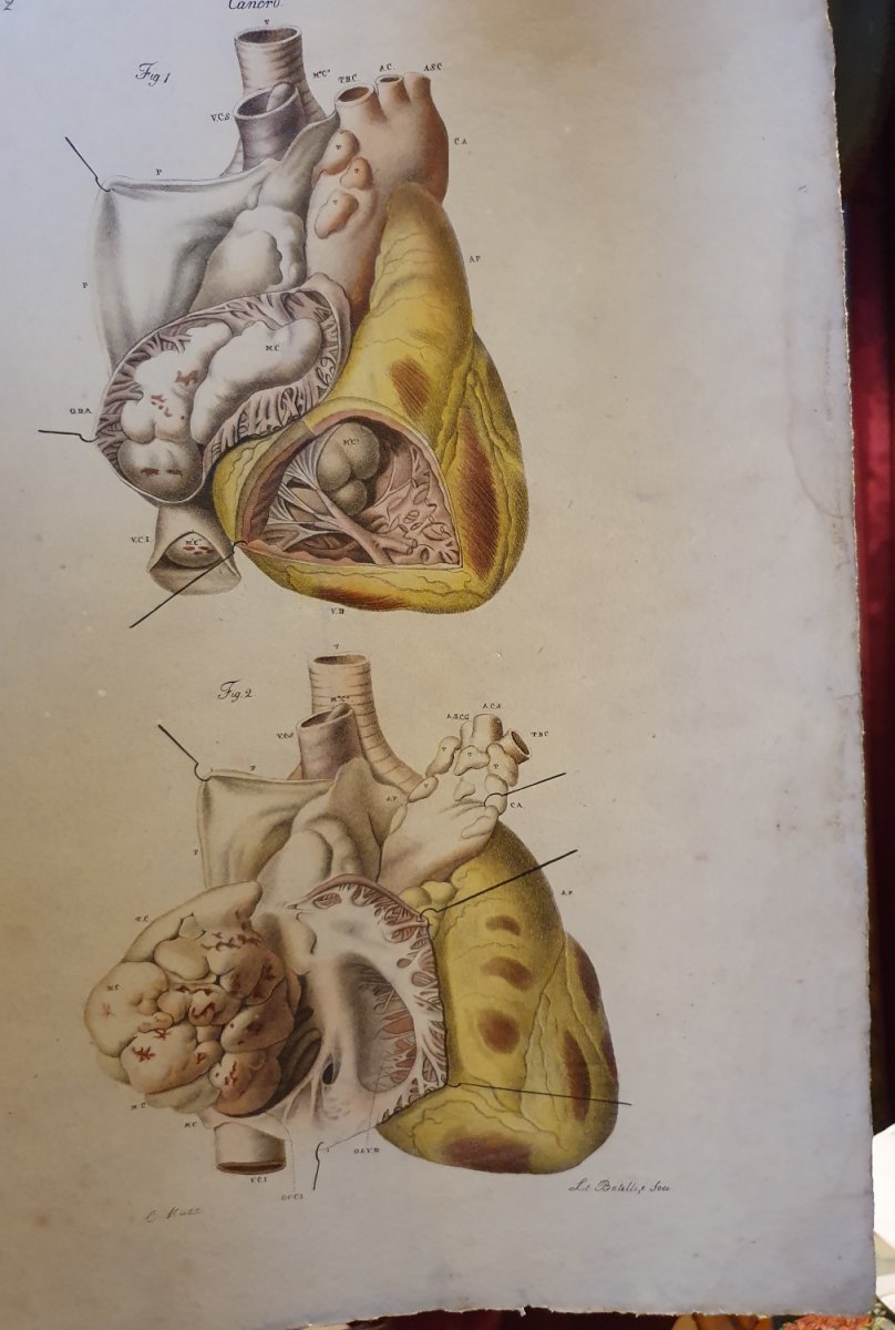 Pathological Anatomical Color Engraving Heart Disease Jean Cruveilhier 1839-photo-4