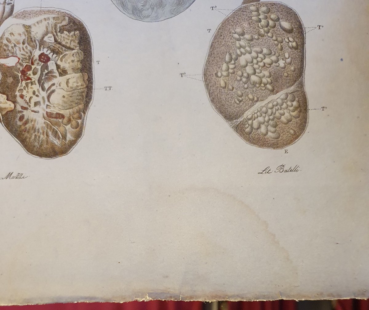 Engraving Colour Anatomical Pathological Testis Disease Jean Cruveilhier 1839-photo-3
