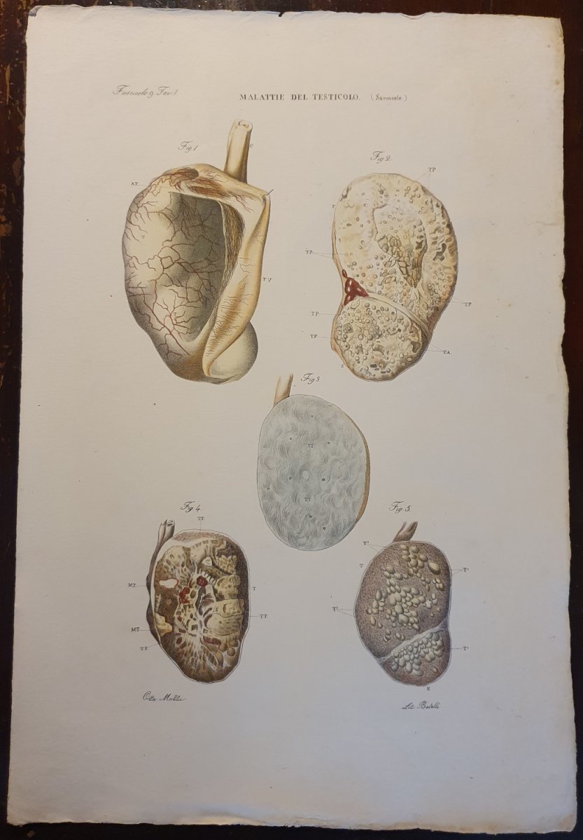 Gravure Couleur Anatomique Pathologique Maladie Des Testicules Jean Cruveilhier 1839