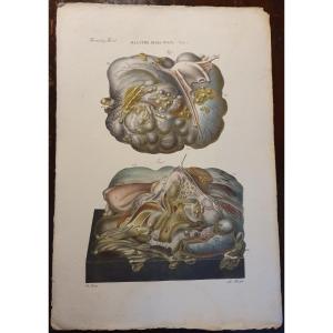 Gravure Couleur Anatomique Pathologique Maladie Kyste Des Ovaires Par Jean Cruveilhier 1839