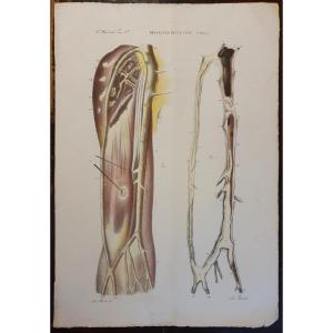 Gravure Couleur Anatomique Pathologique Maladie Phlébite Par Jean Cruveilhier 1839 