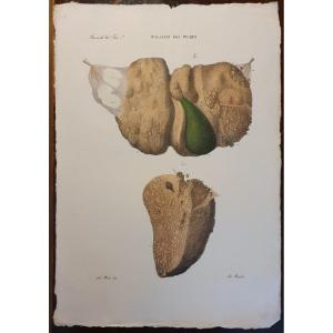 Gravure Couleur Anatomique Pathologique Maladie Cirrhose Du Foie Par Jean Cruveilhier 1839