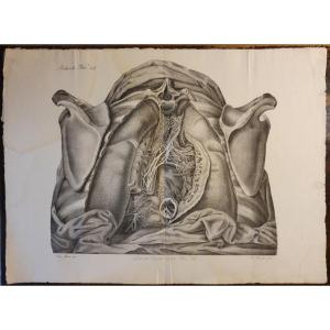 Gravure Noir Et Blanc Anatomique Pathologique Atlante Generale Par Jean Cruveilhier 1839