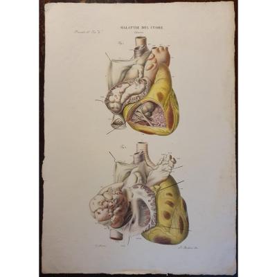 Pathological Anatomical Color Engraving Heart Disease Jean Cruveilhier 1839