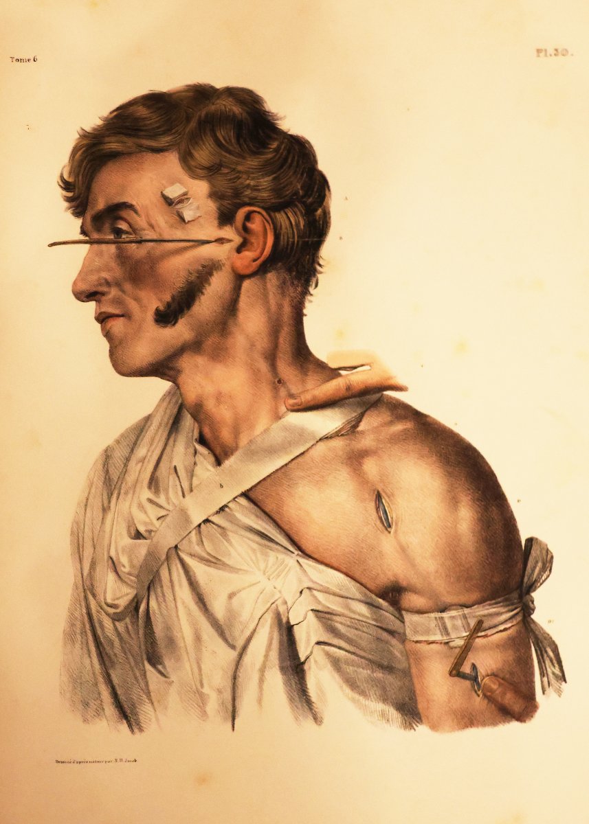 Traité Complet De l'Anatomie De l'Homme.. Dr Jean-marc Bourgery, Paris Par L. Guérin. 1866-1867-photo-1