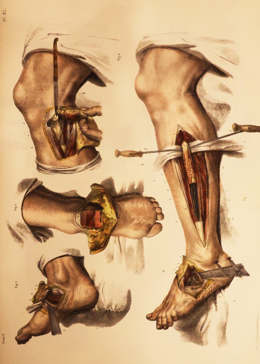 Traité Complet De l'Anatomie De l'Homme.. Dr Jean-marc Bourgery, Paris Par L. Guérin. 1866-1867-photo-2