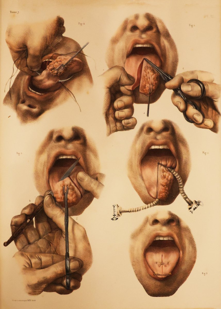 Traité Complet De l'Anatomie De l'Homme.. Dr Jean-marc Bourgery, Paris Par L. Guérin. 1866-1867-photo-3