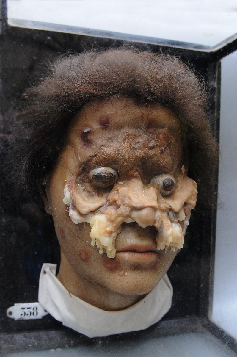 Medical Wax Cast Of Syphilitic Buboes, Late 19th Century-photo-2