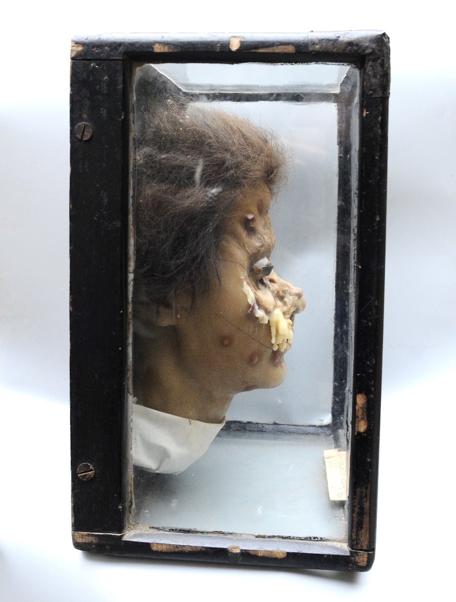 Medical Wax Cast Of Syphilitic Buboes, Late 19th Century-photo-1