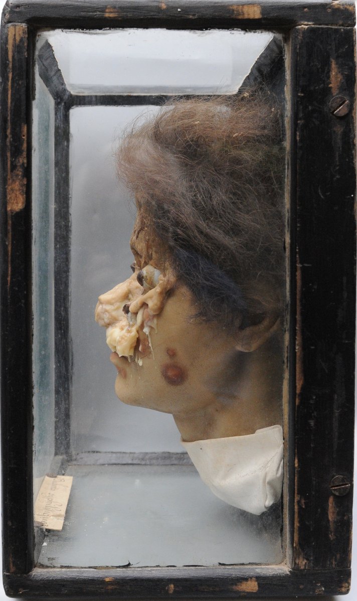 Medical Wax Cast Of Syphilitic Buboes, Late 19th Century-photo-4