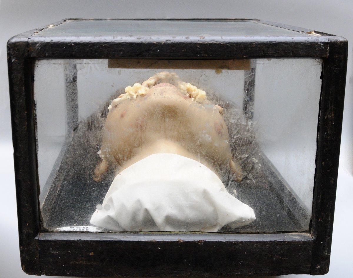 Medical Wax Cast Of Syphilitic Buboes, Late 19th Century-photo-7
