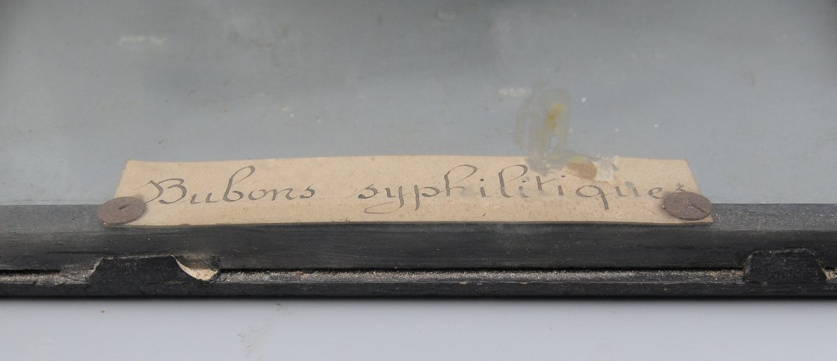 Medical Wax Cast Of Syphilitic Buboes, Late 19th Century-photo-8