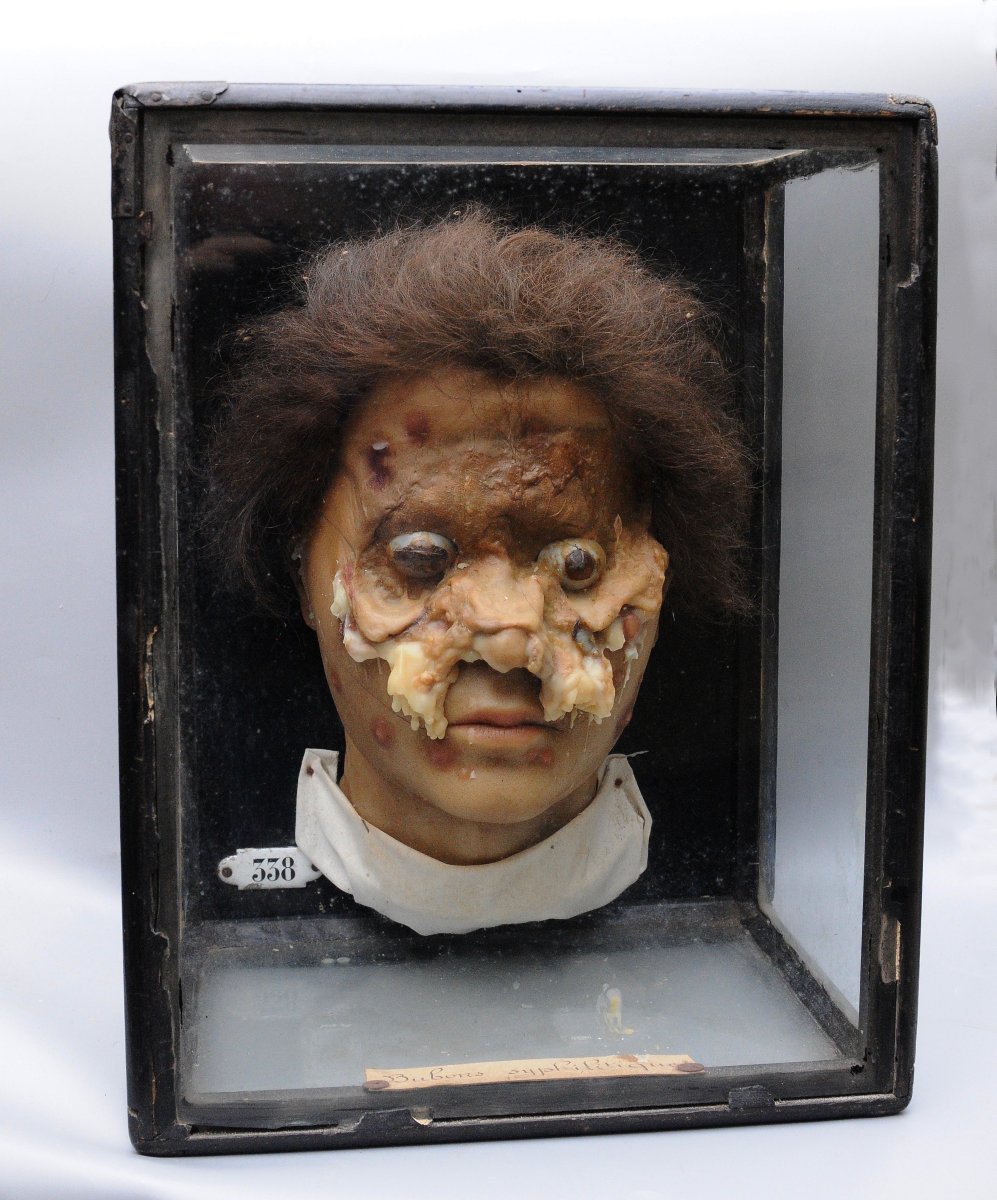 Medical Wax Cast Of Syphilitic Buboes, Late 19th Century