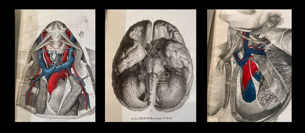 Medecine Anatomie Chirurgie Obstetrique. Atlas De 143 Planches. Vers 1850.-photo-4