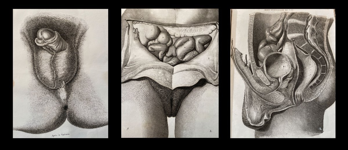 Medecine Anatomie Chirurgie Obstetrique. Atlas De 143 Planches. Vers 1850.-photo-1