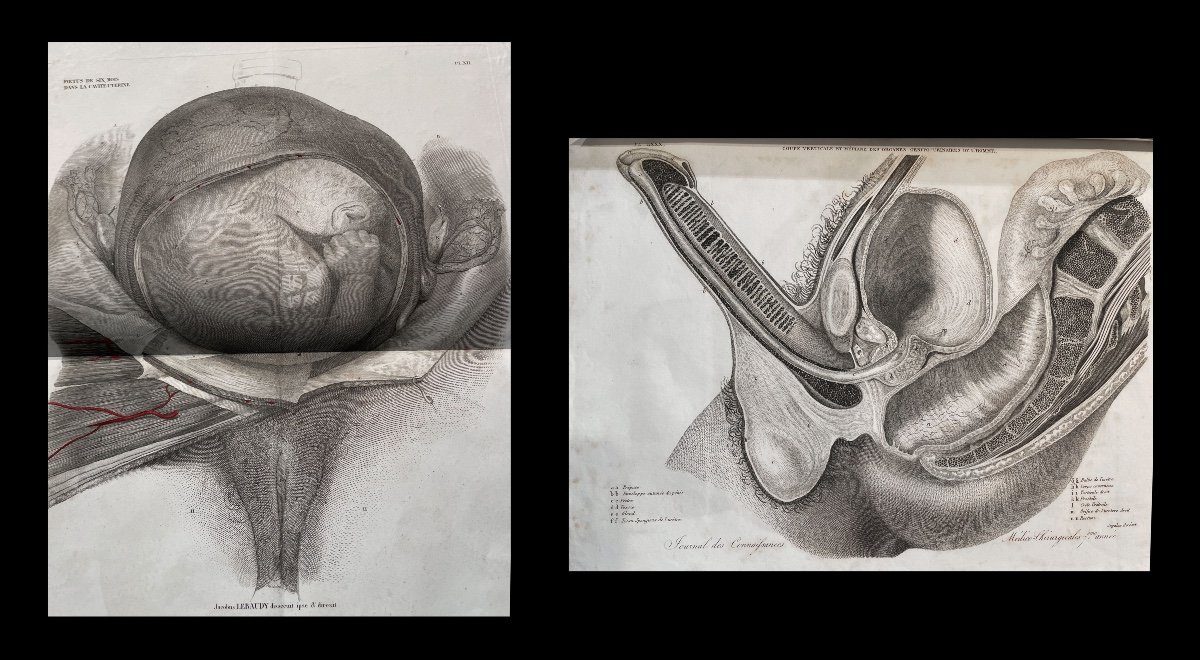 Medecine Anatomie Chirurgie Obstetrique. Atlas De 143 Planches. Vers 1850.-photo-2