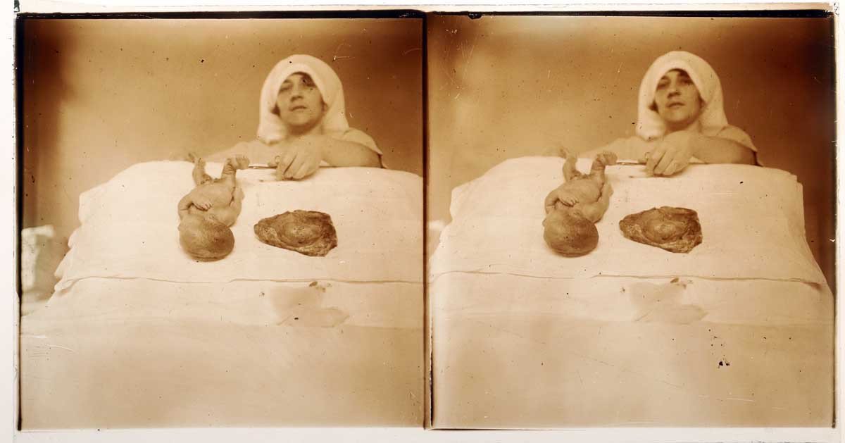 photographies 13 STÉRÉOS MÉDICALES GYNÉCOLOGIE vers 1900 - 1920-photo-4