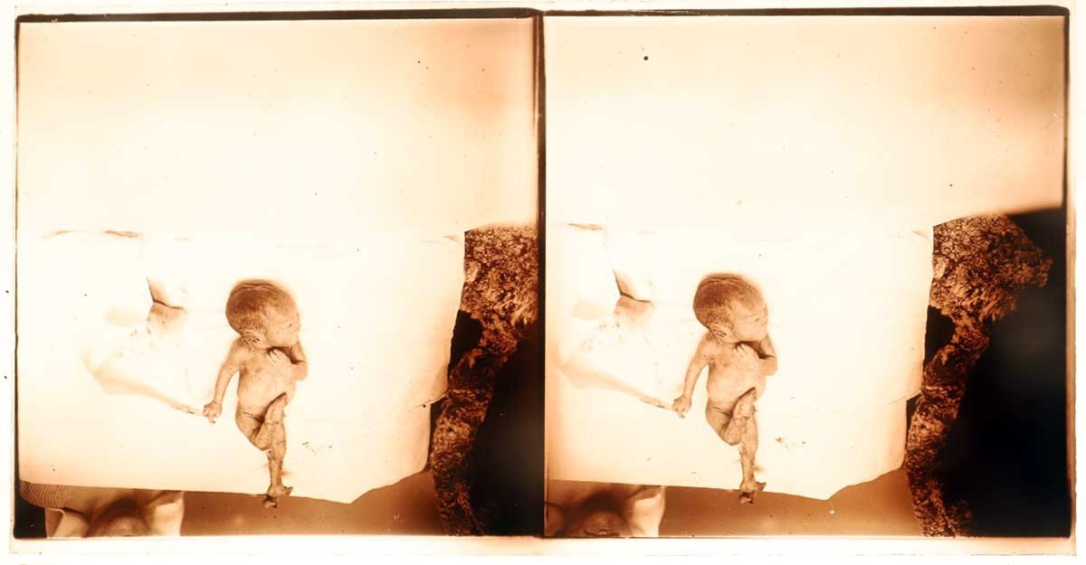 photographies 13 STÉRÉOS MÉDICALES GYNÉCOLOGIE vers 1900 - 1920-photo-5
