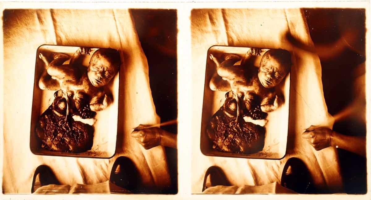photographies 13 STÉRÉOS MÉDICALES GYNÉCOLOGIE vers 1900 - 1920-photo-6