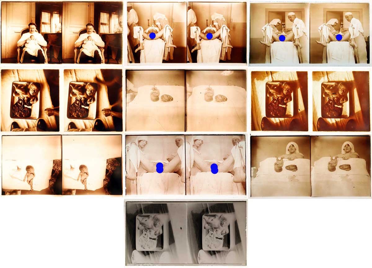 photographies 13 STÉRÉOS MÉDICALES GYNÉCOLOGIE vers 1900 - 1920