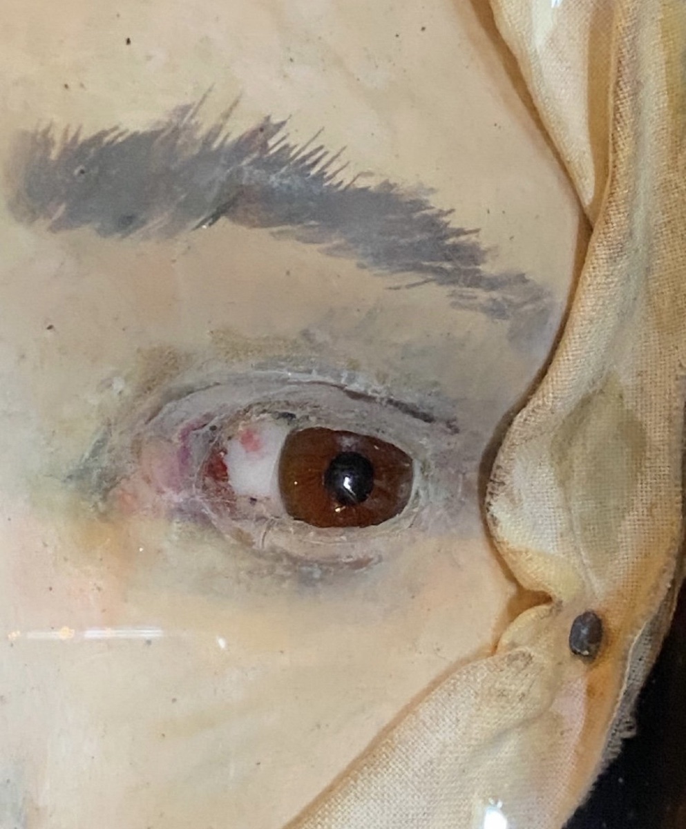 Divergent Strabismus – Anatomical Wax Model Of The Eye, Circa 1900-photo-3