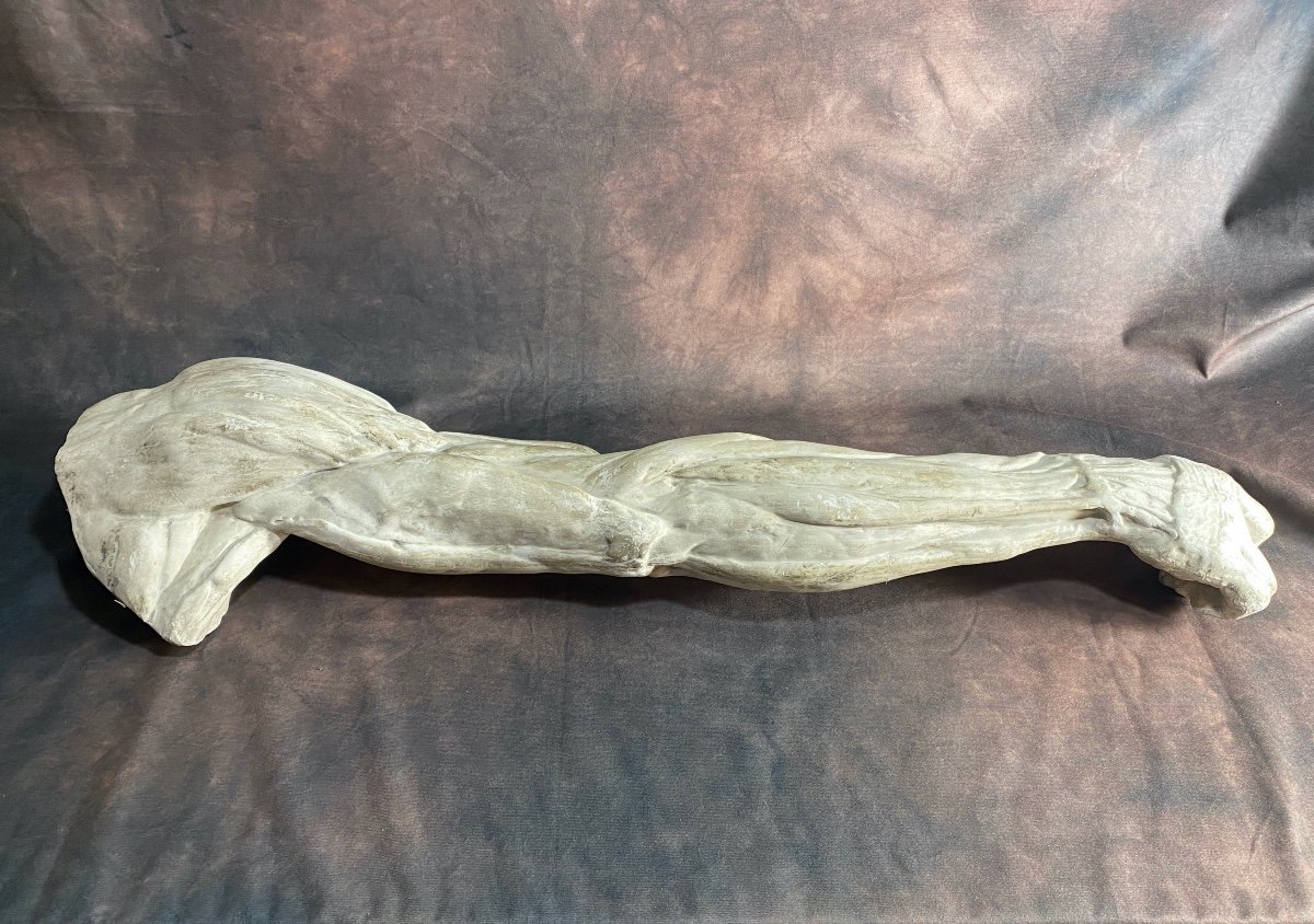 Skinned Arm In Plaster
