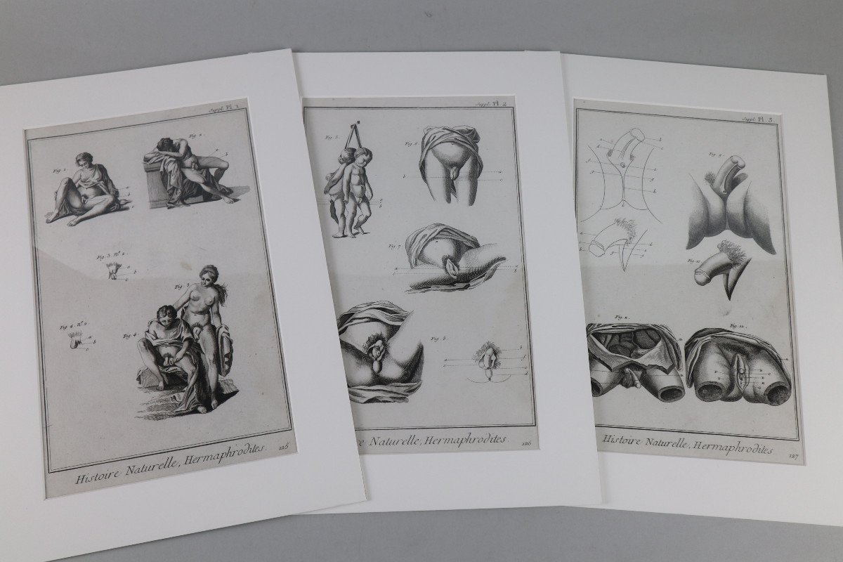 Hermaphrodites. Three Original Plates From The Encyclopedia Of Diderot And d'Alembert.
